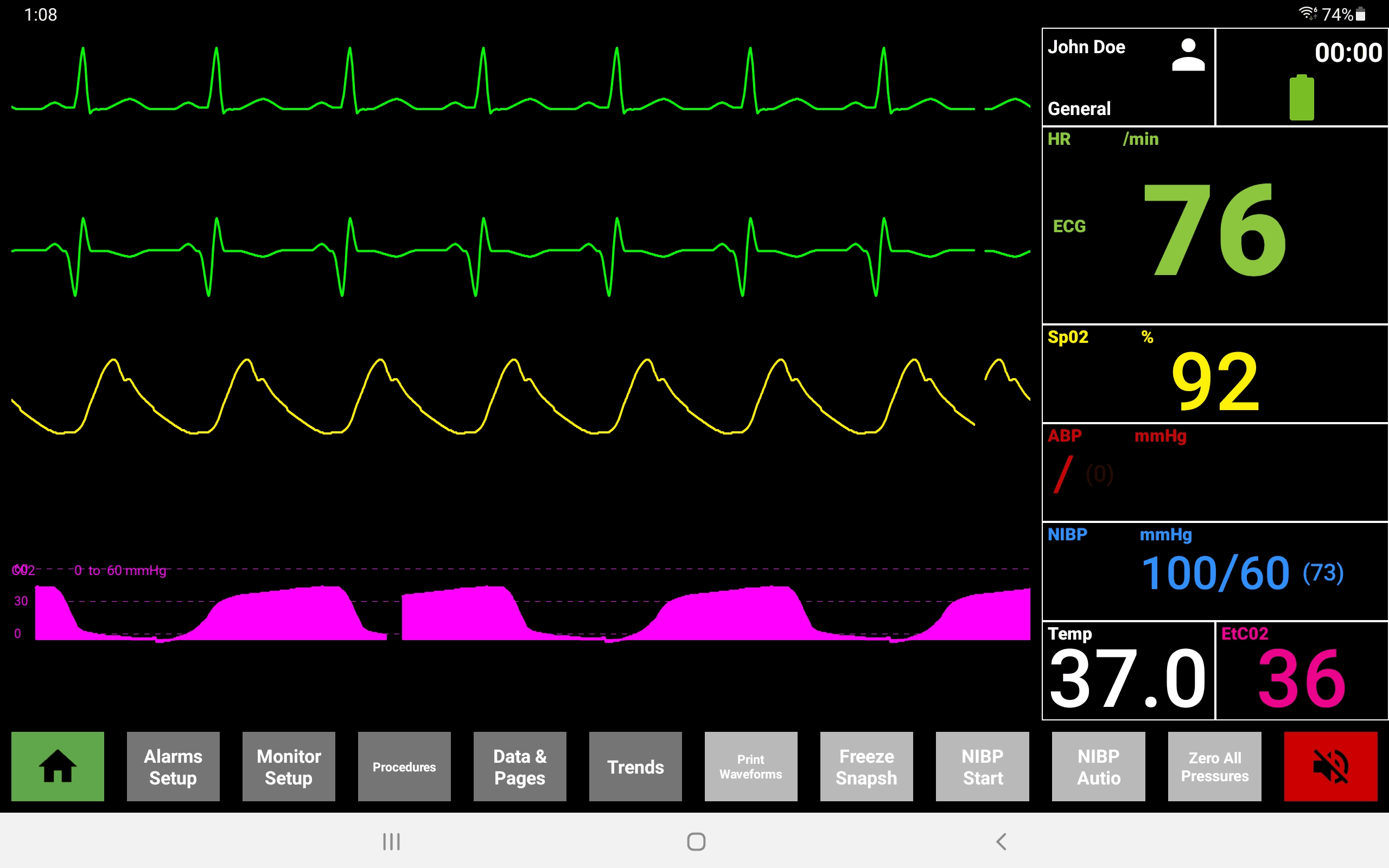 Hospital Monitor interface showing ECG, pleth, ABP, and capnography waveforms with vitals panel and toolbar
