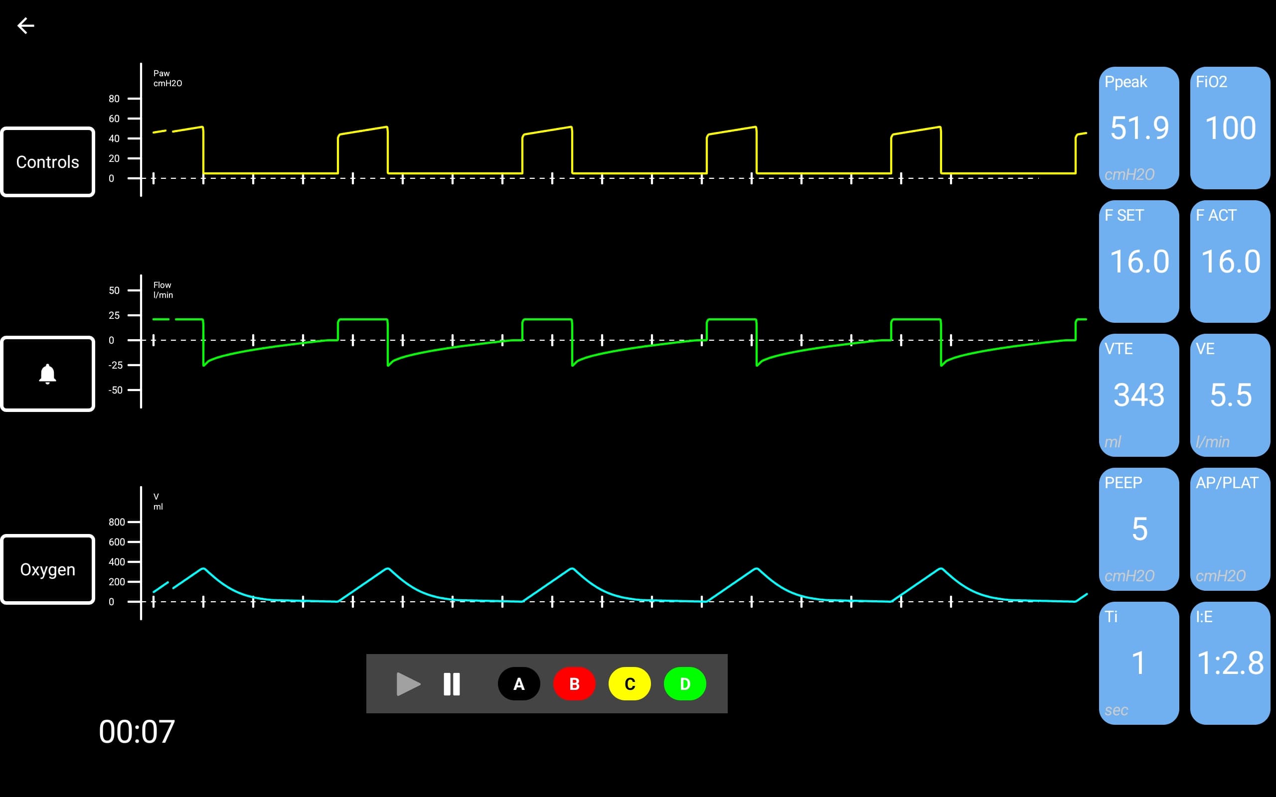 Mechanical Ventilator student interface showing Paw, Flow, and Volume waveforms with ventilator parameters panel