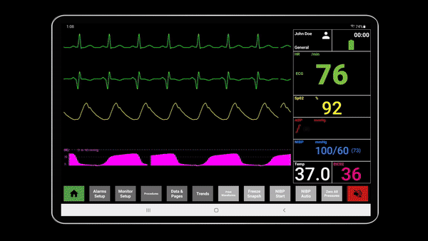 A live SimVS patient monitor running on a tablet, showing ECG, SpO2, and vital signs at the bedside.